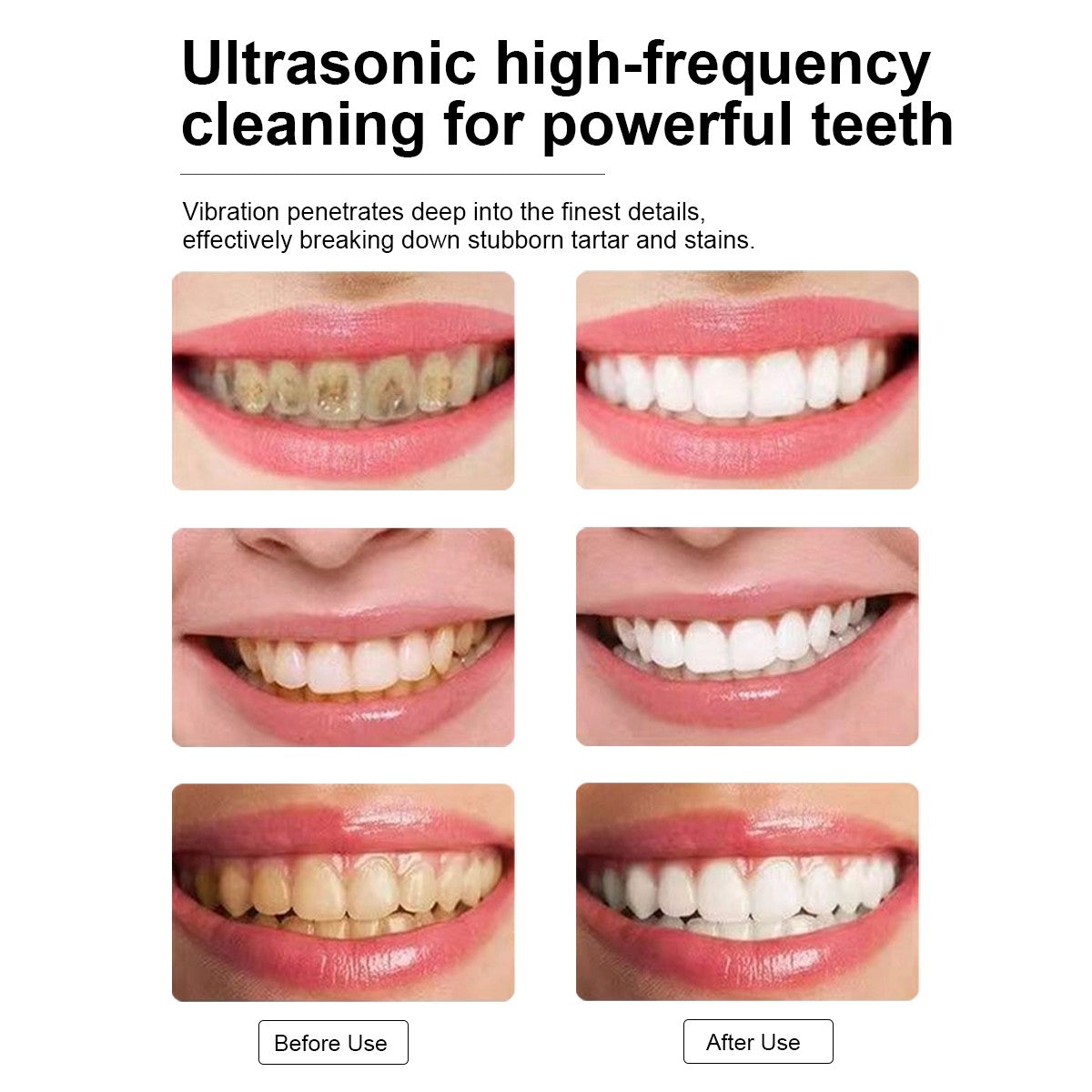Ultrasonic Dental Tartar Remover Kit - Safe Painless Tooth Cleaner & Plaque Remover