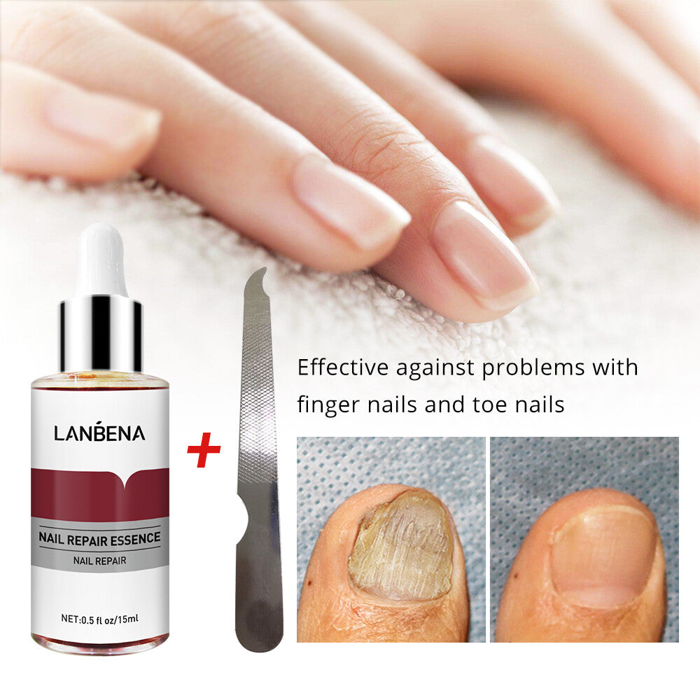 Ginger Antibacterial Nail Treatment Serum for Fungal Repair - 2PCS