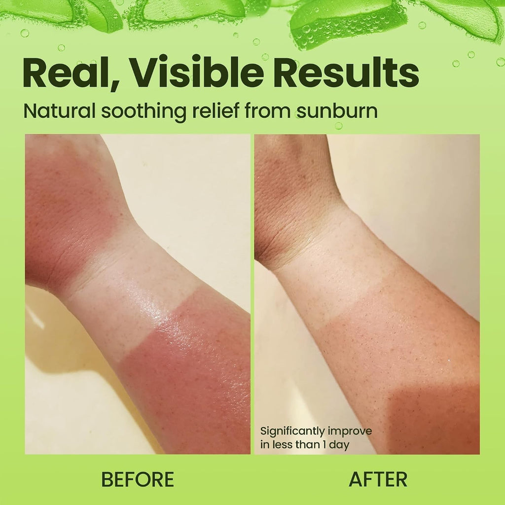 Aloe Vera Gel for Sunburn and Dry Skin - Natural Ingredients 8 Fl Oz
