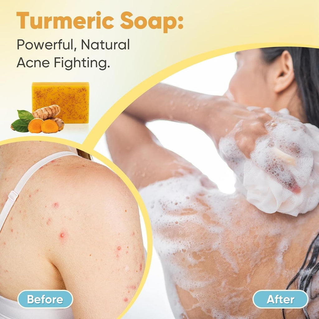 Turmeric & Kojic Acid Face Soap for Acne & Brightening - 5 Bars 3.5 Oz