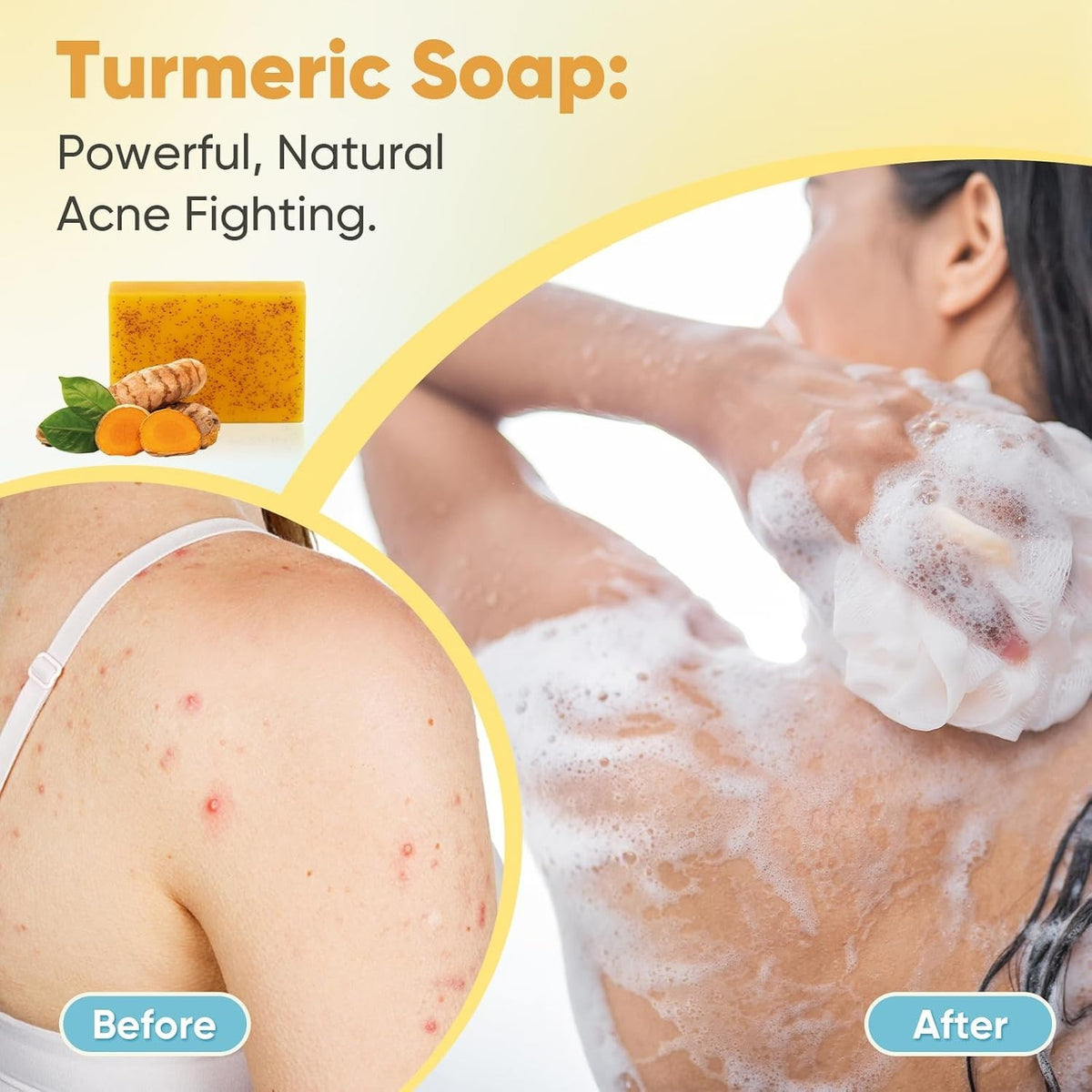 Turmeric & Kojic Acid Face Soap for Acne & Brightening - 5 Bars 3.5 Oz