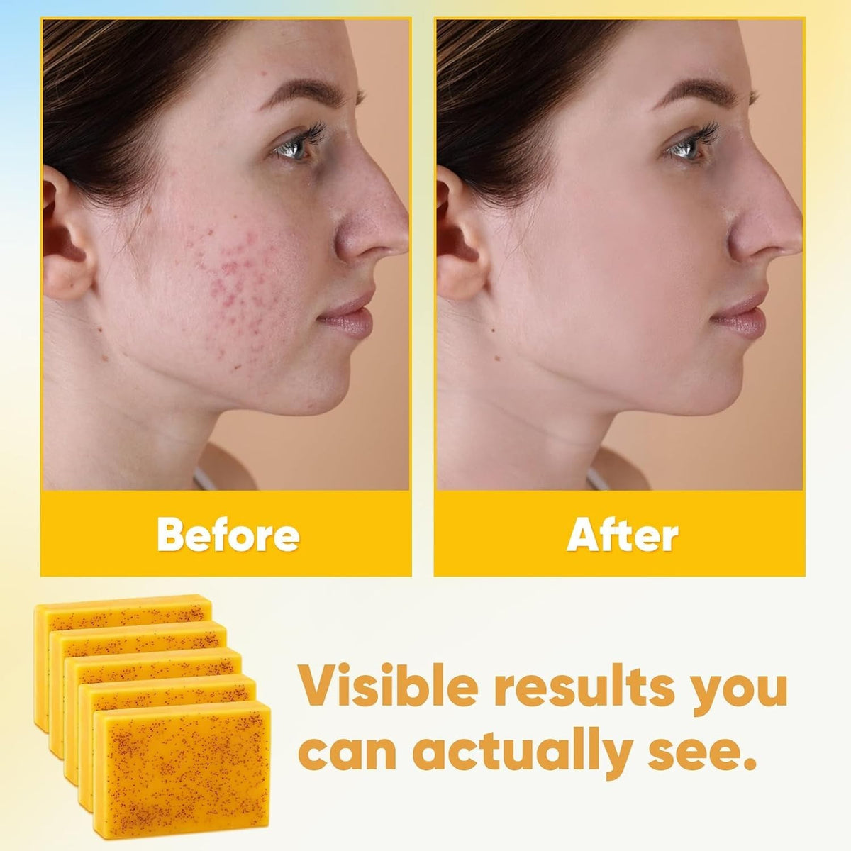 Turmeric & Kojic Acid Face Soap for Acne & Brightening - 5 Bars 3.5 Oz