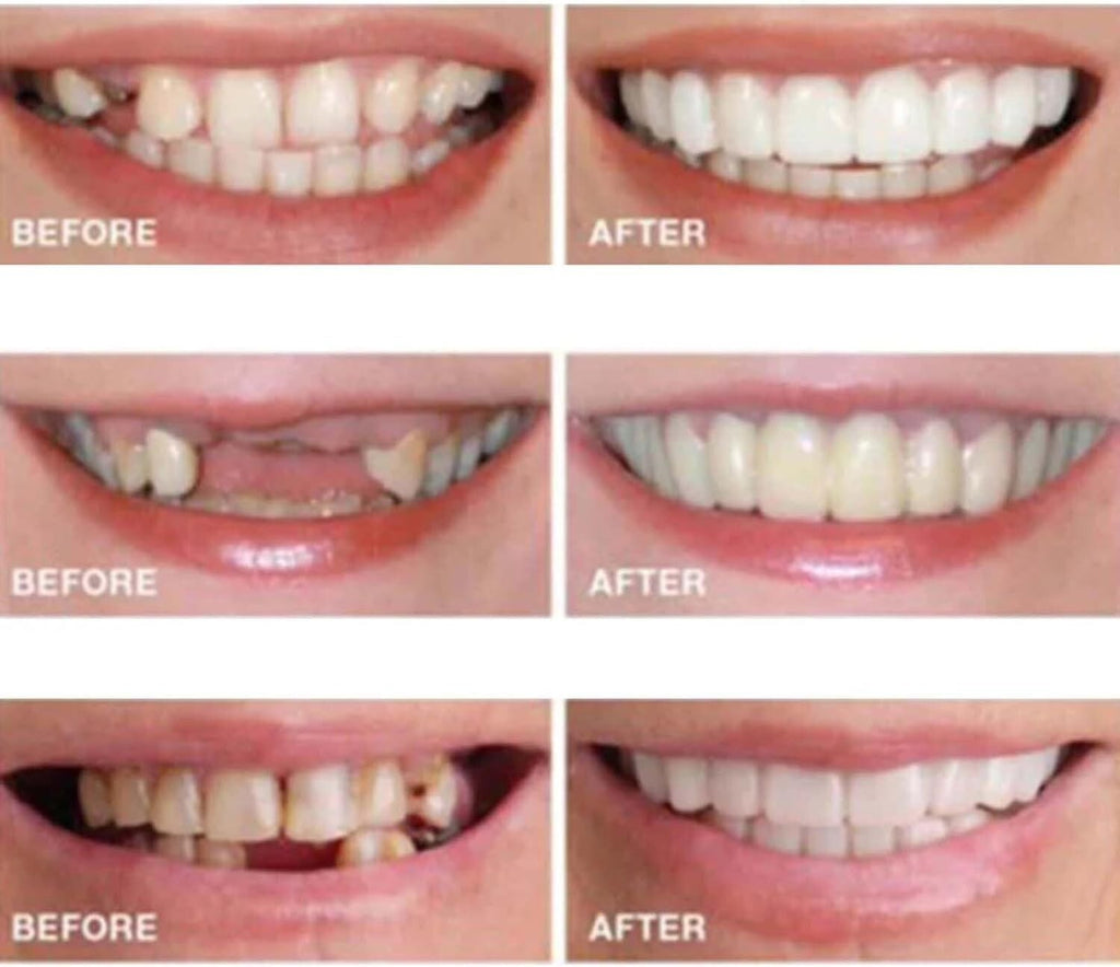 Snap-On Veneers Fake Teeth Kit for Women & Men - 2 Pieces Smile Enhancer