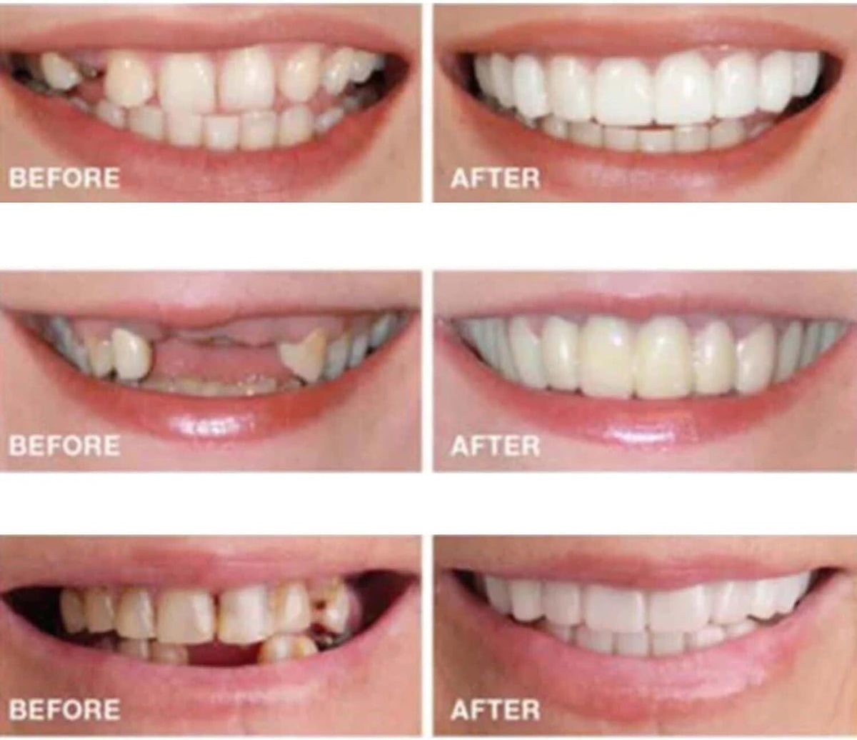 Snap-On Veneers Fake Teeth Kit for Women & Men - 2 Pieces Smile Enhancer