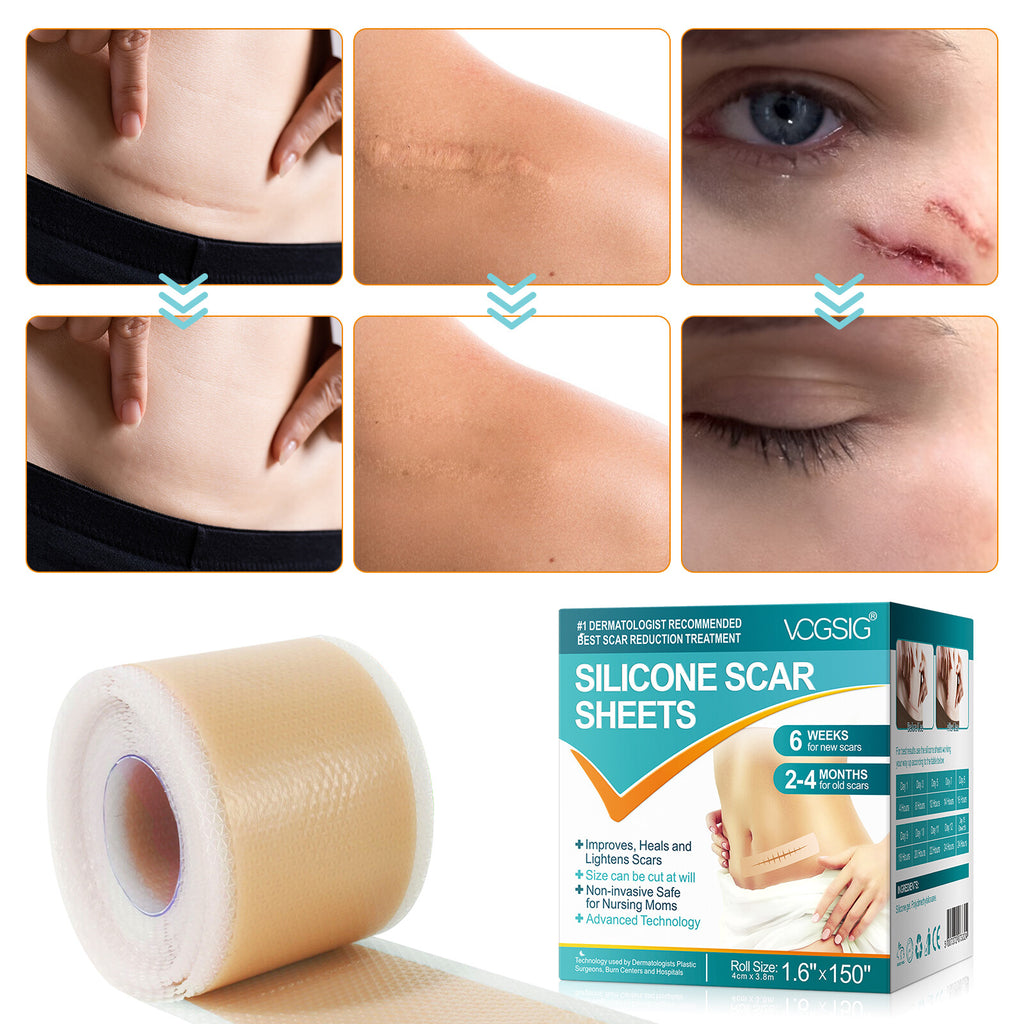 Scar Removal Silicone Tape for Hypertrophic Scars & Keloids - 1.6" x 60"-150"