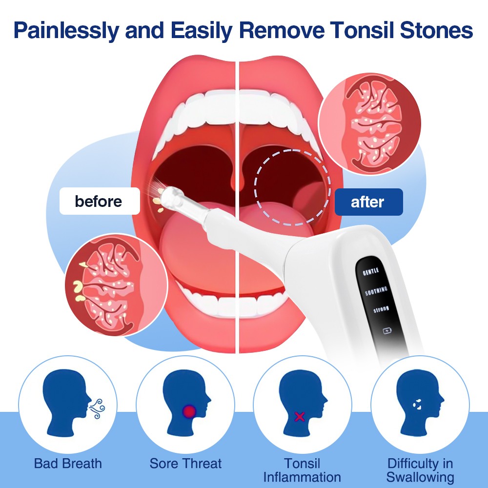 Electronic Tonsil Stone Removal Kit with HD Camera, LED Light & 3 Suction Modes