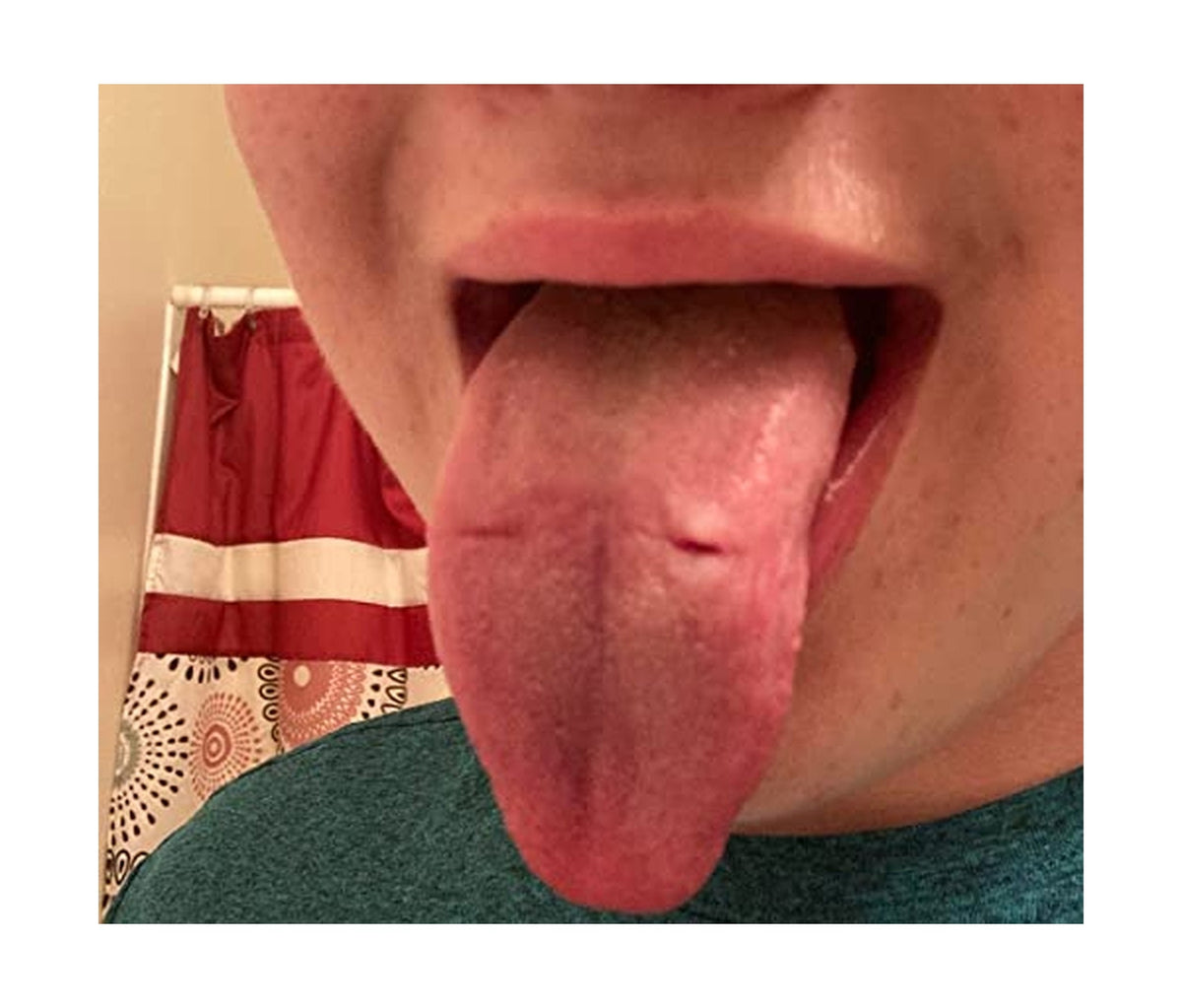 Tongue Guard for Dental Expanders - Prevents & Heals Tongue Sores, Custom Fit, 3 Trays
