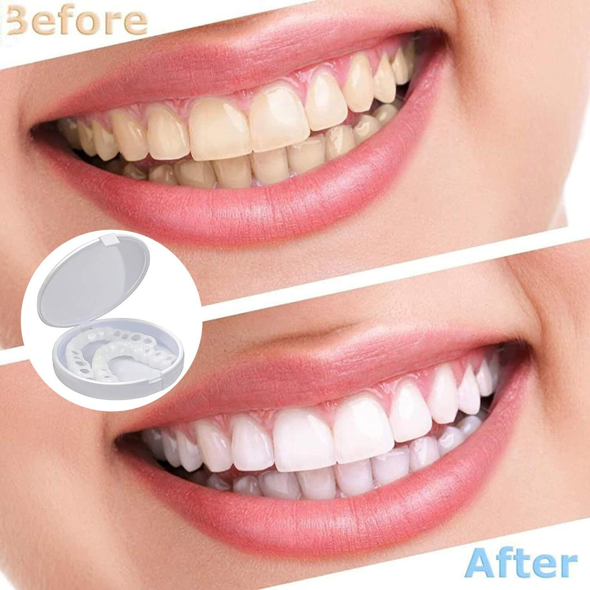 Snap-On Upper and Lower Dental Veneers Set - Reusable Teeth Cover for Adults