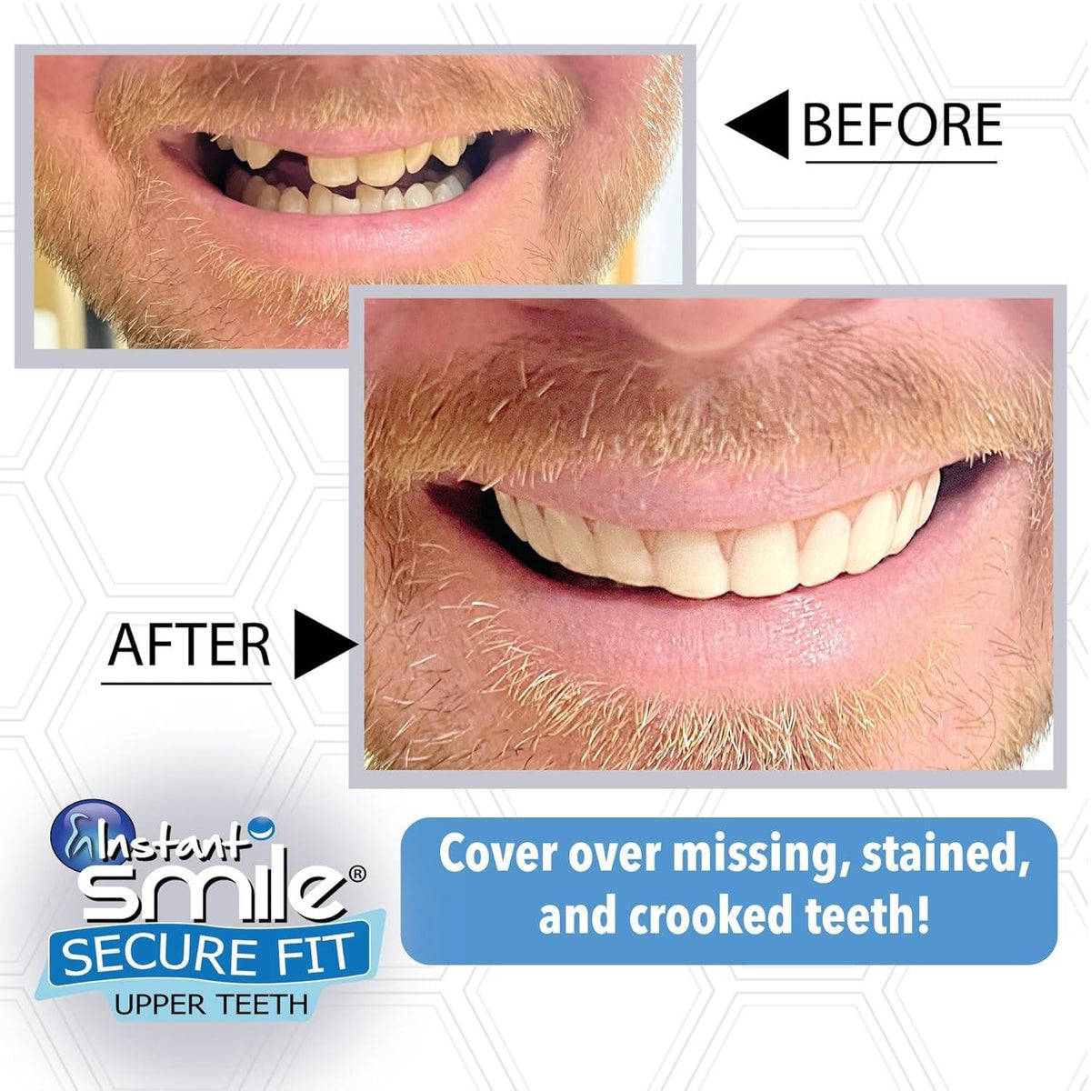 Instant Smile Upper Teeth Veneer - Natural Shade, Reusable Fit Over Existing Teeth