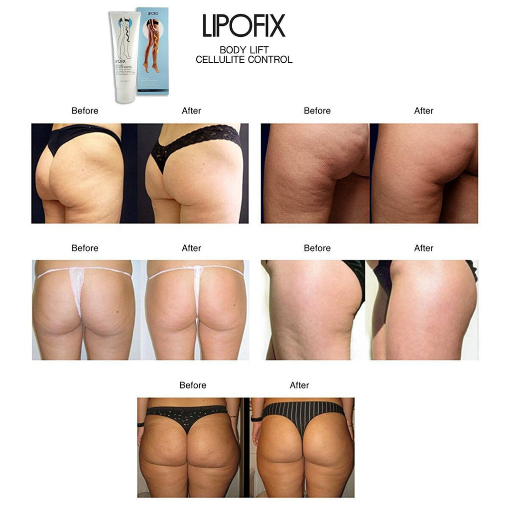 Anti Cellulite Cream for Fat Burning and Skin Firming - Lipofix