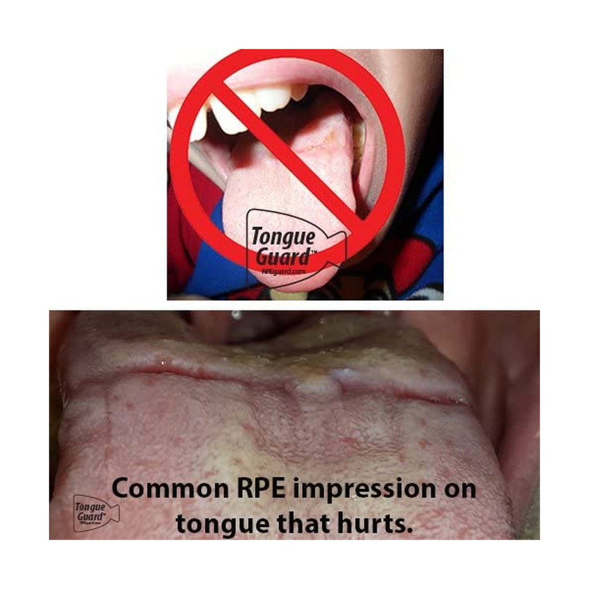 Tongue Guard for Dental Expanders - Prevents & Heals Tongue Sores, Custom Fit, 3 Trays