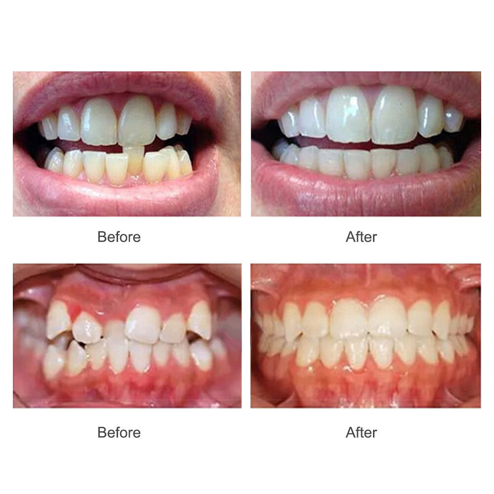 Adult Teeth Aligners Orthodontic Braces Trainer for Dental Alignment - 3 Stage