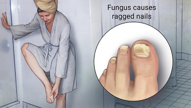Natural Nail Fungus Treatment for Toe & Finger Nails - Heal & Restore