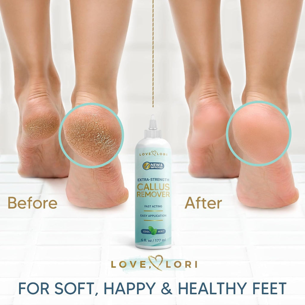 Extra Strength Foot Callus Remover Gel for Smooth Feet – 6Oz