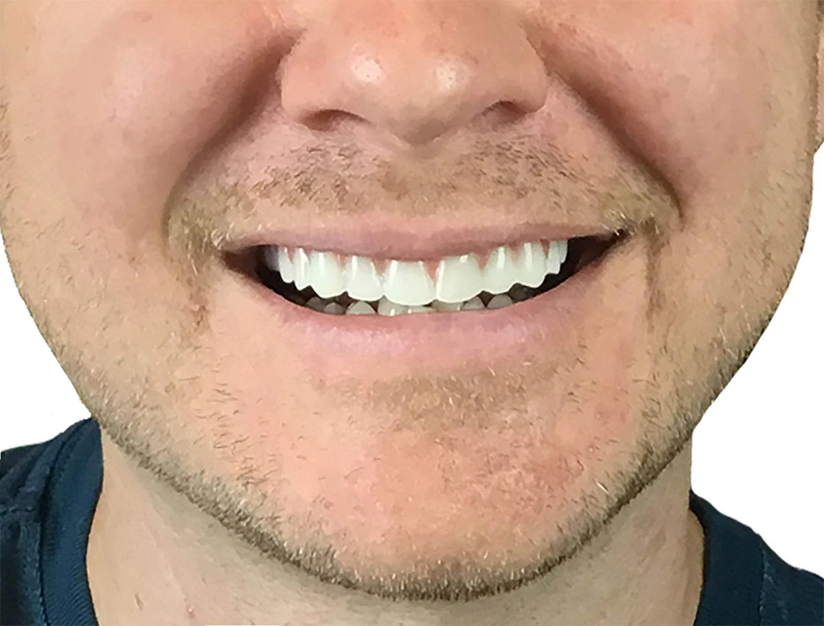 Natural Shade Dental Veneer Set - Comfort Fit Cosmetic Teeth