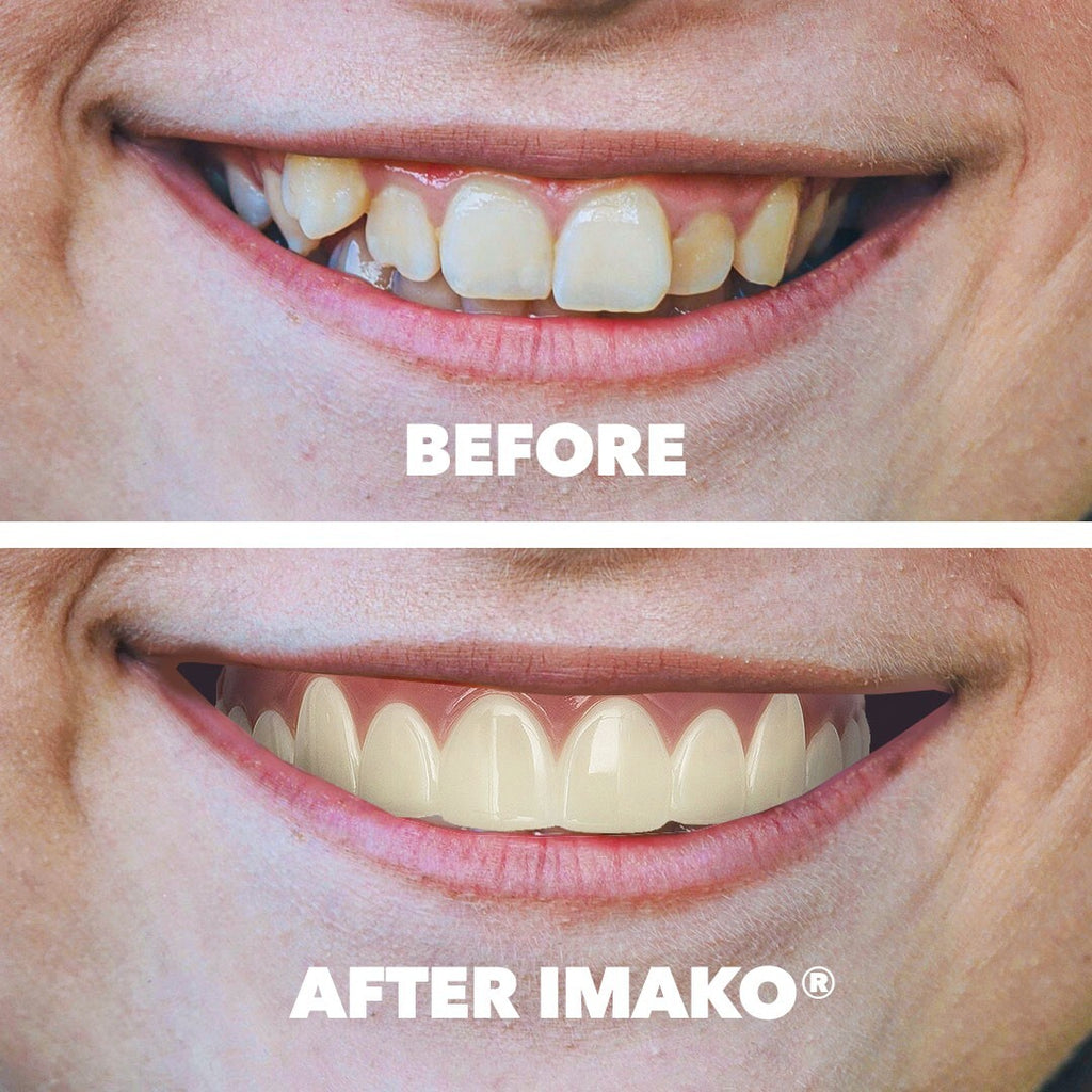 Cosmetic Teeth Small Bleached White 2-Pack - Temporary Smile Makeover
