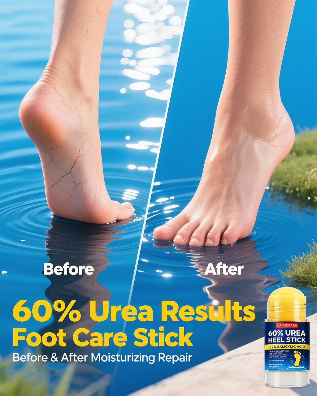 Urea Foot Cream Stick 60% with Salicylic Acid for Cracked Heels & Dry Skin