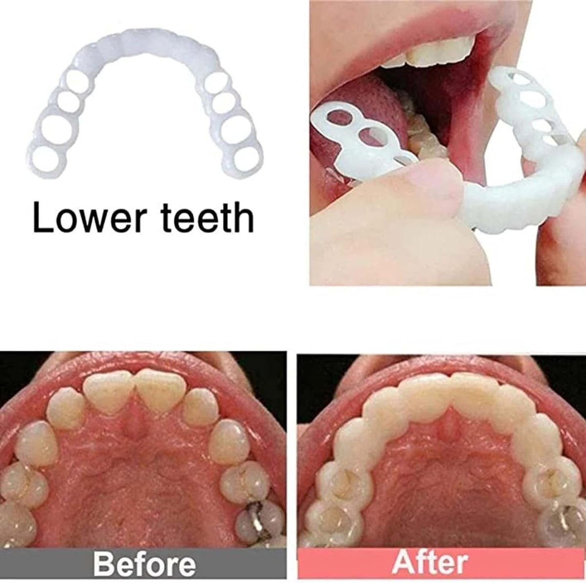 Temporary Dental Veneers Kit - Instant Smile Makeover for Men & Women