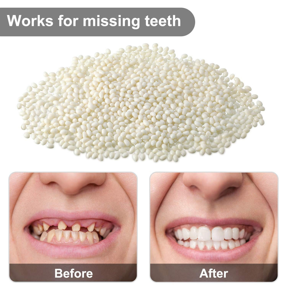 Tooth Repair Kit Moldable Beads for Temporary Dental Fixes - 100g, White