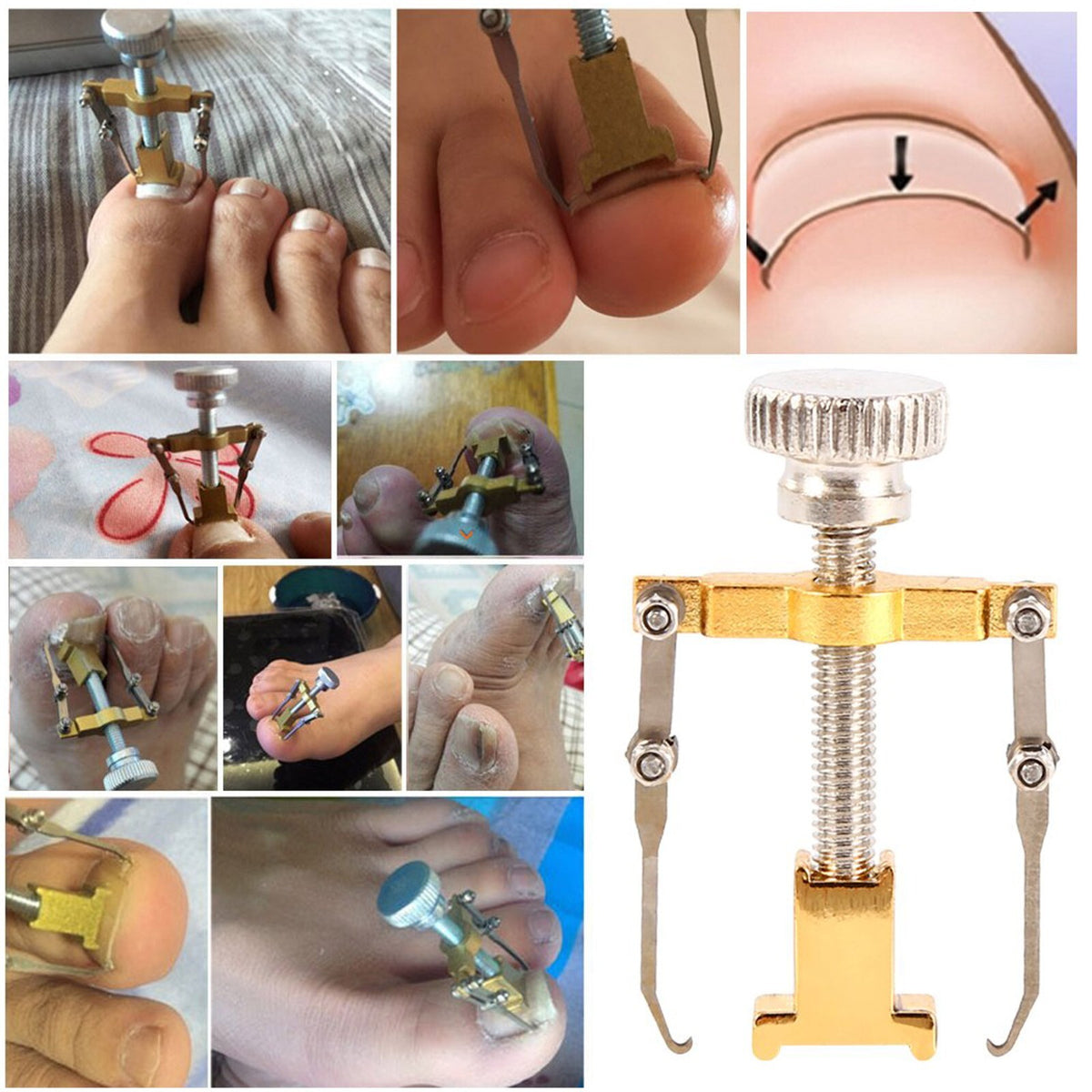 Ingrown Toenail Correction Lifter Tool - Nail Straightener & Paronychia Fixer
