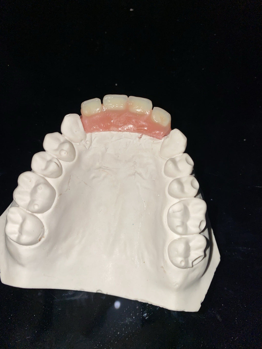 Missing Tooth Kit for Front Teeth Replacement Acrylic Teeth Set - A2 Shade