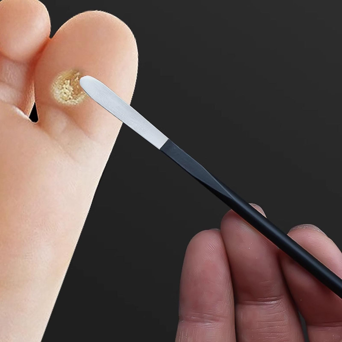 Corn Remover Pedicure Tool for Feet - Stainless Steel Callus and Wart Remover