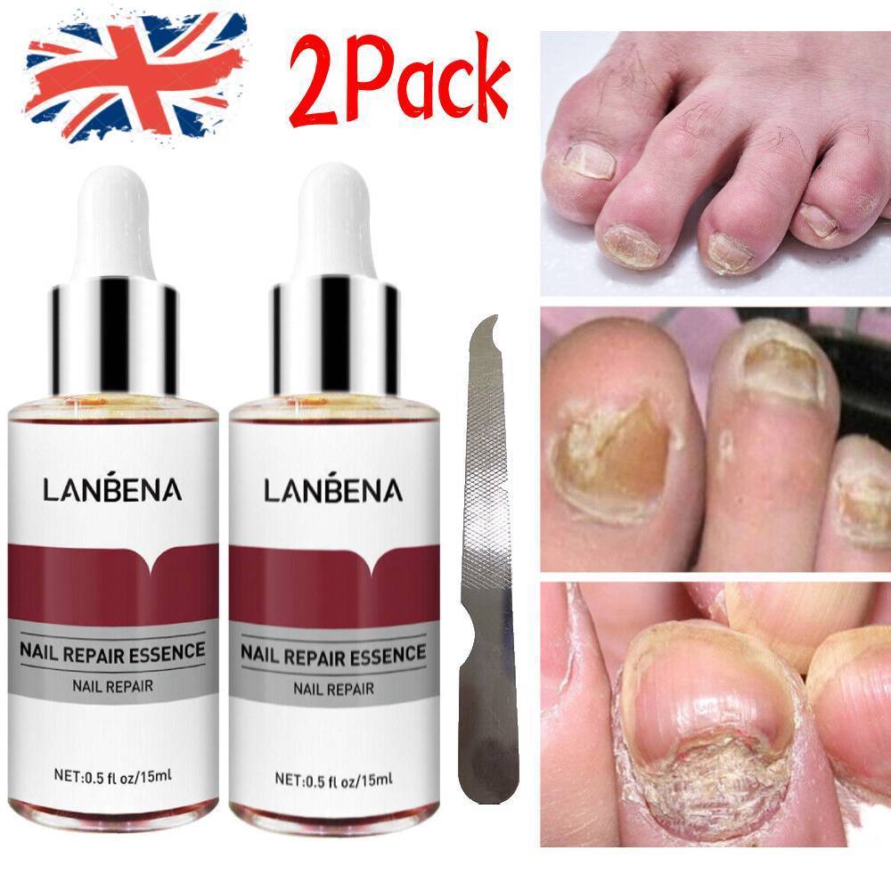 Ginger Antibacterial Nail Treatment Serum for Fungal Repair - 2PCS