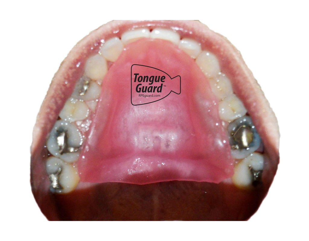 Tongue Guard for Dental Expanders - Prevents & Heals Tongue Sores, Custom Fit, 3 Trays