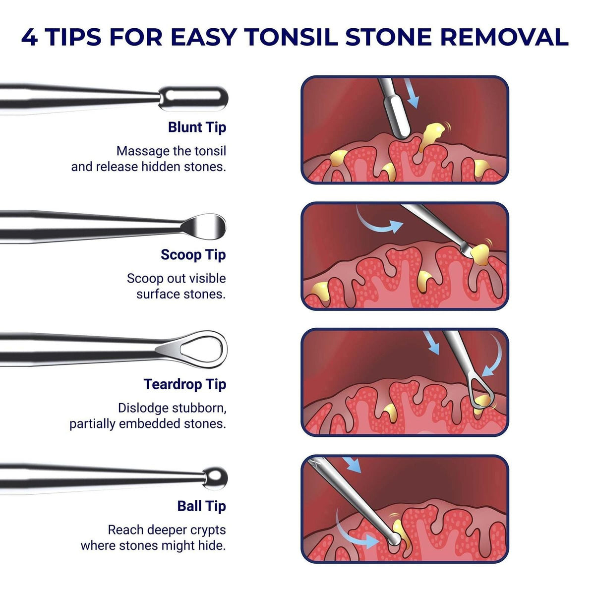 Tonsil Stone Remover Tool Pack of 2 - Metal Oral Hygiene Tools