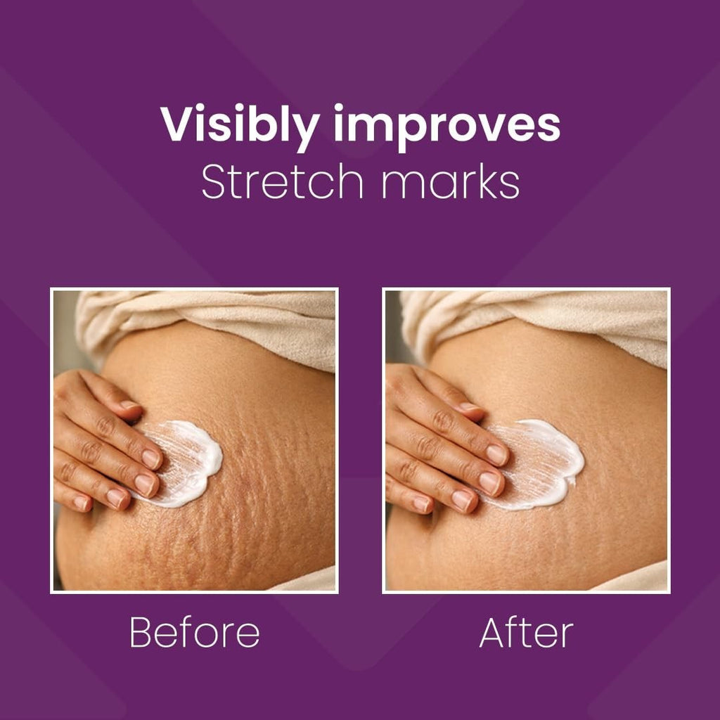 Mederma Stretch Marks Therapy 50g + Free Face Wash 20g - Skin Care Set