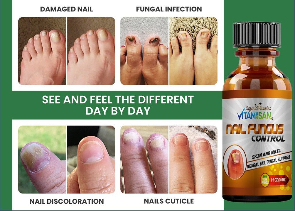 Maximum Strength Antifungal Toenail & Foot Support Spray for Athlete's Foot