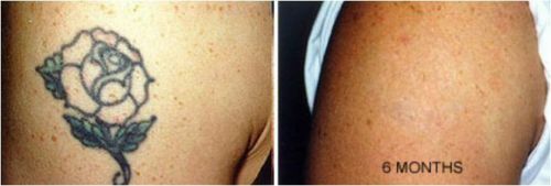 Tattoo Removal Cream – Painless Maximum Strength Fading Solution