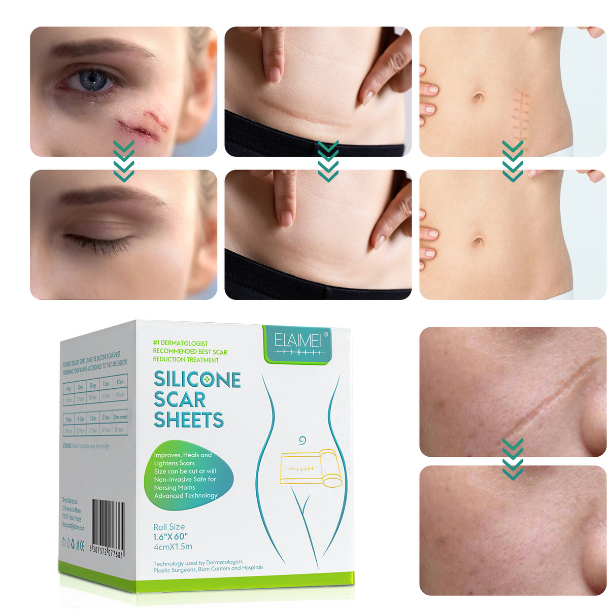Silicone Scar Removal Tape for Hypertrophic & Keloid Scars - 1.6" x 60-150"