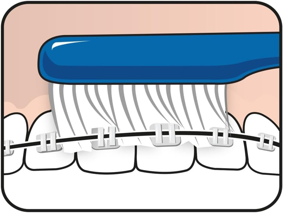 Orthodontic Soft Toothbrush with Narrow Head & Flexible Neck for Braces & Implants