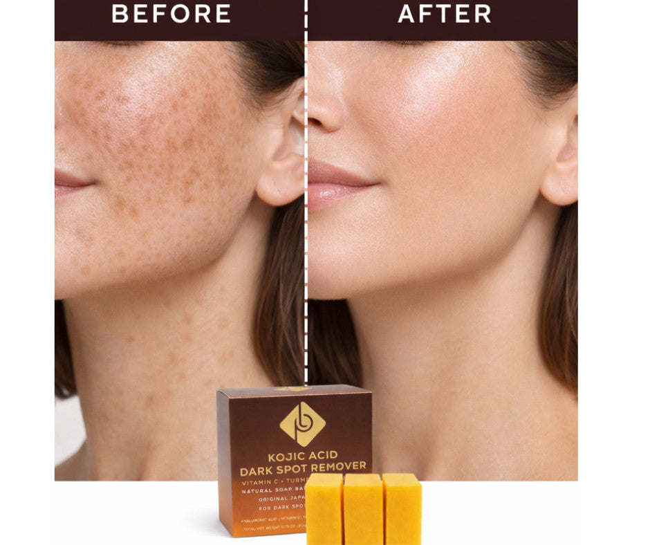 Kojic Acid Dark Spot Remover Soap Bars with Vitamin C, Retinol, Turmeric - 3 Pack