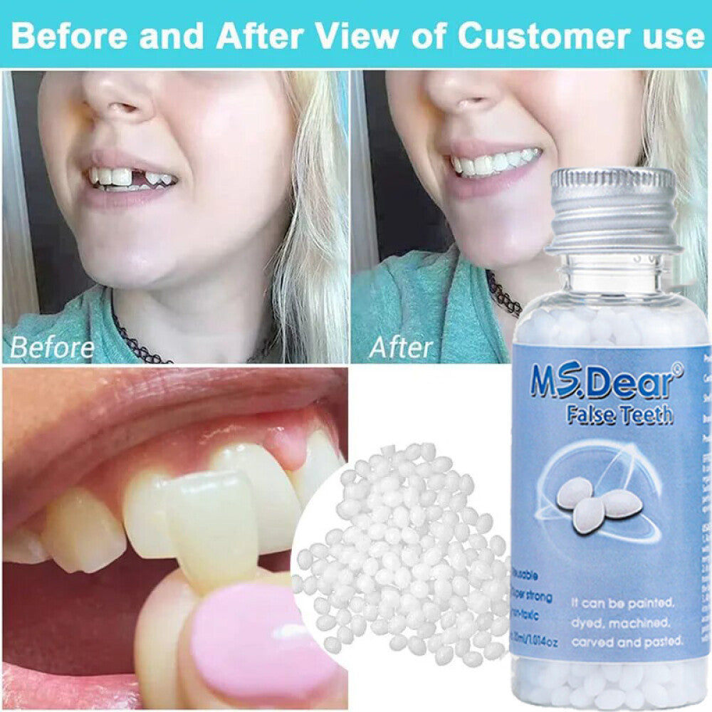 Temporary Moldable Dental Repair Beads for Broken Teeth - 30ml