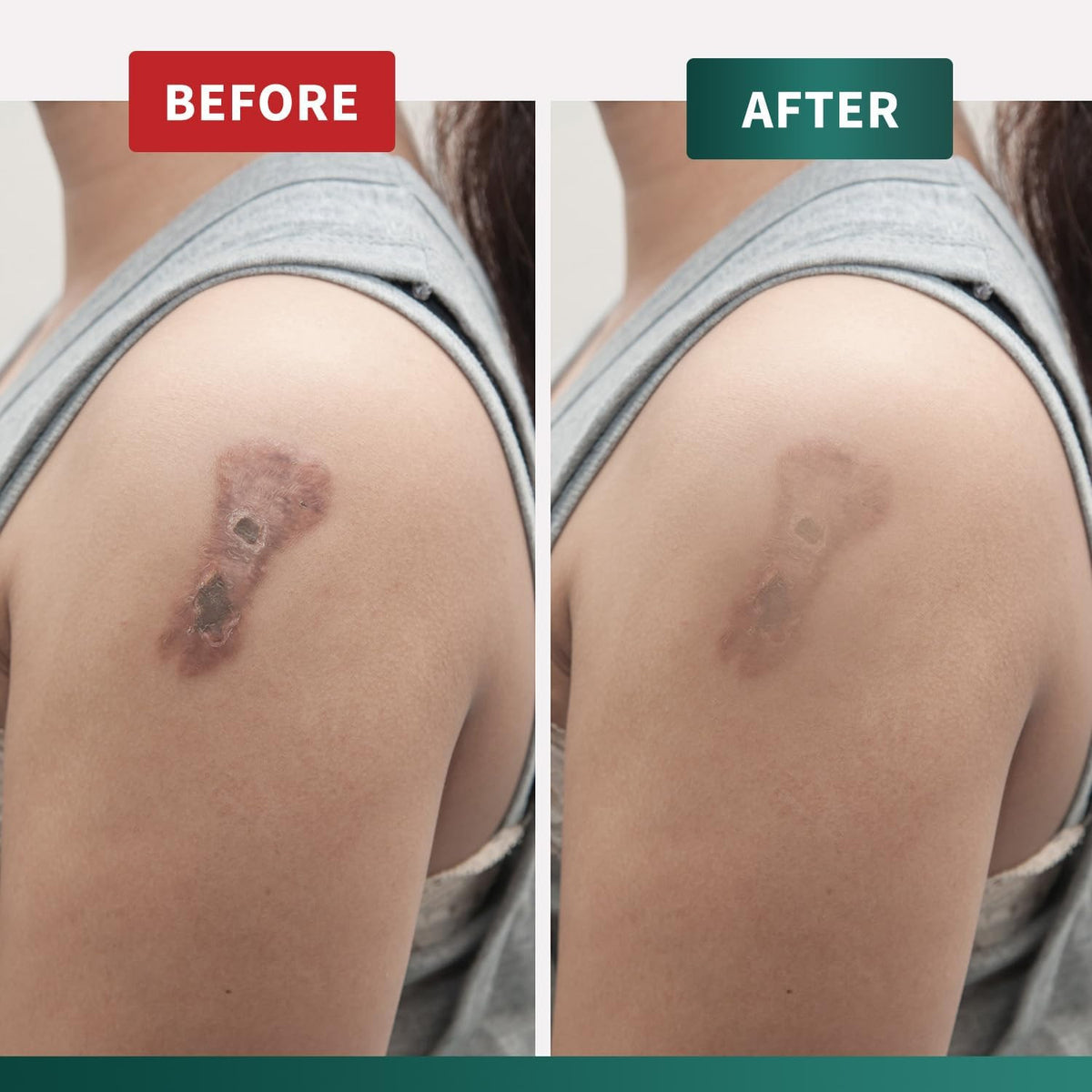 Silicone Scar Cream for Surgical, Keloid & Injury Scars - Moisturizing Gel