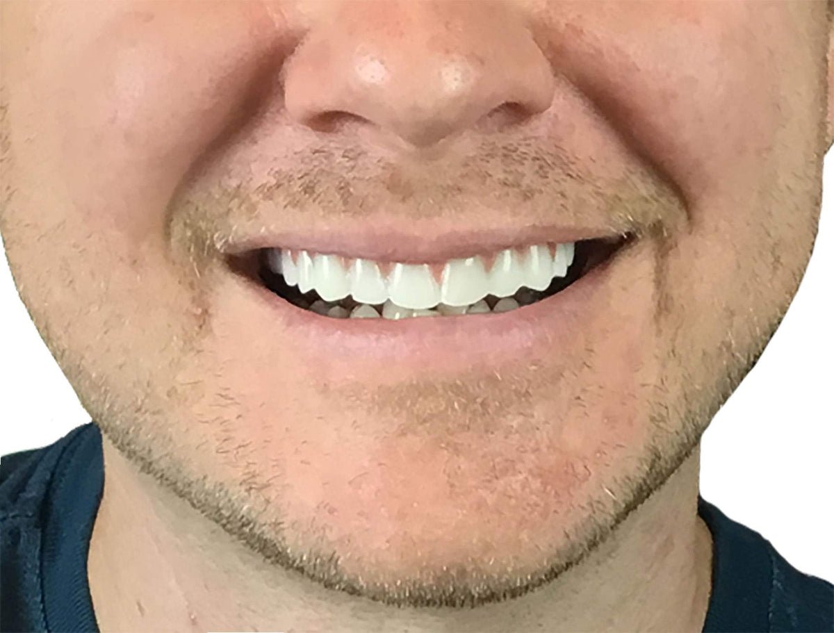 Natural Shade Upper Veneer Cosmetic Teeth - Comfort Fit Flex