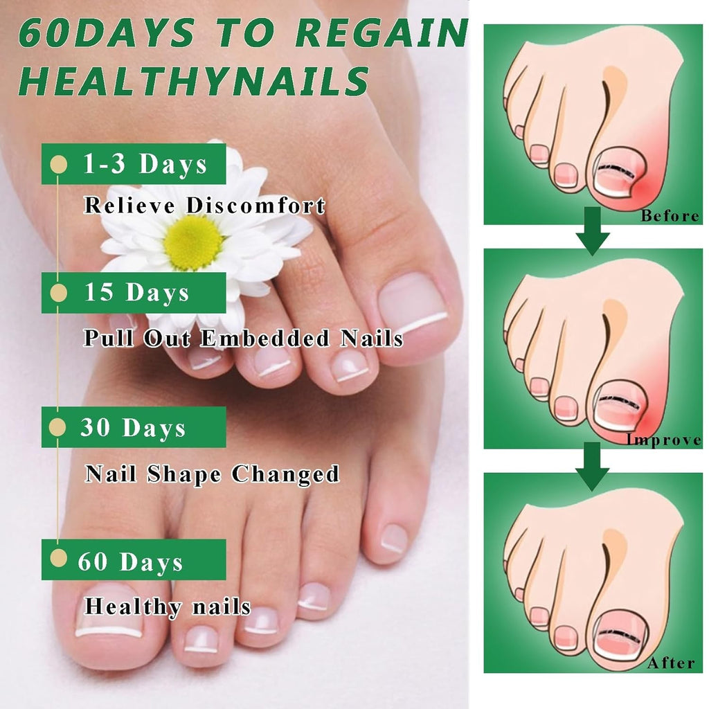 Ingrown Toenail Correction Patch Kit - Nail Fix & Deformation Treatment