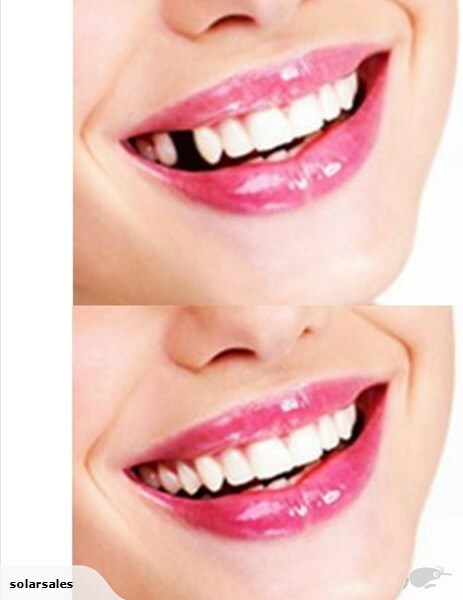 Thermal Fitting Beads for Dental Temporary Restorations - Pack of 12