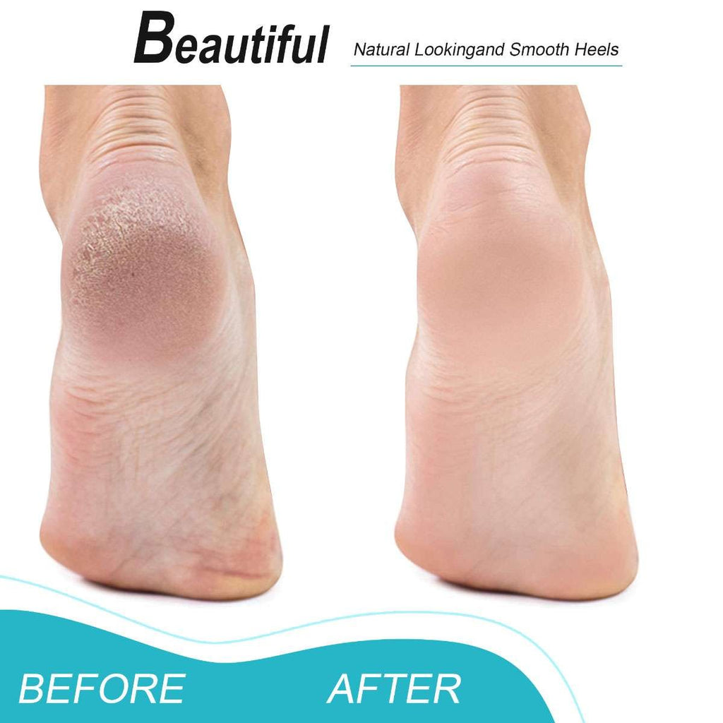Foot Pumice Stones 4 Pack for Callus Removal & Hard Skin Exfoliation