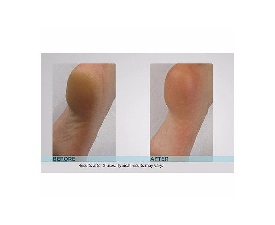 Callus Remover Foot File with Extra Coarse Roller - Portable Callus Pedicure Tool