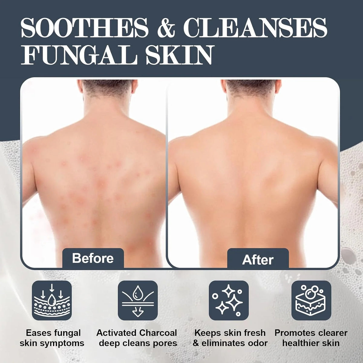 Antifungal Body & Face Soap with Tea Tree & Eucalyptus – 3 Bars