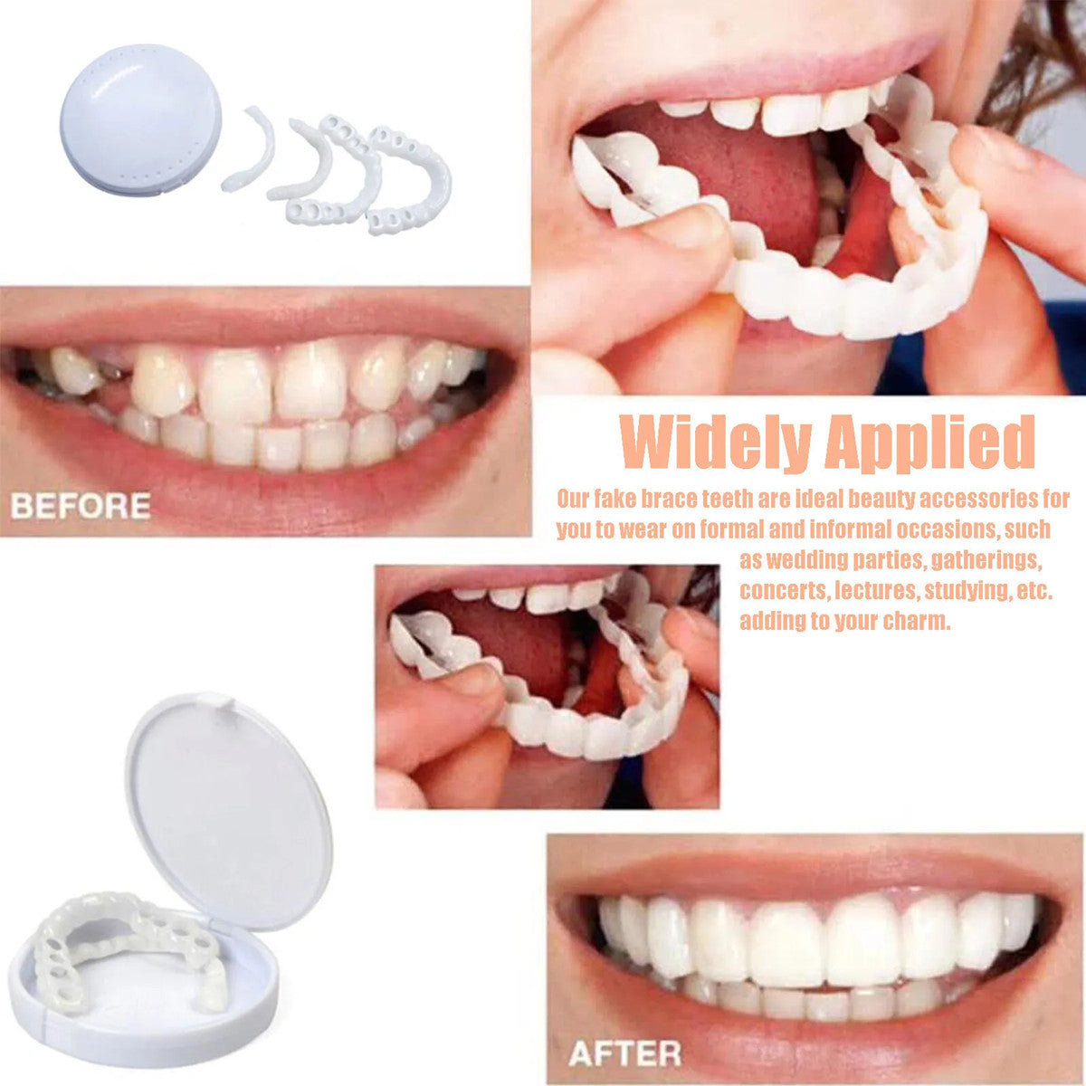Snap-On Upper and Lower Dental Veneers Set for Adults - Reusable Teeth Covers
