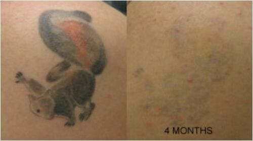 Tattoo Removal Cream – Painless Maximum Strength Fading Solution