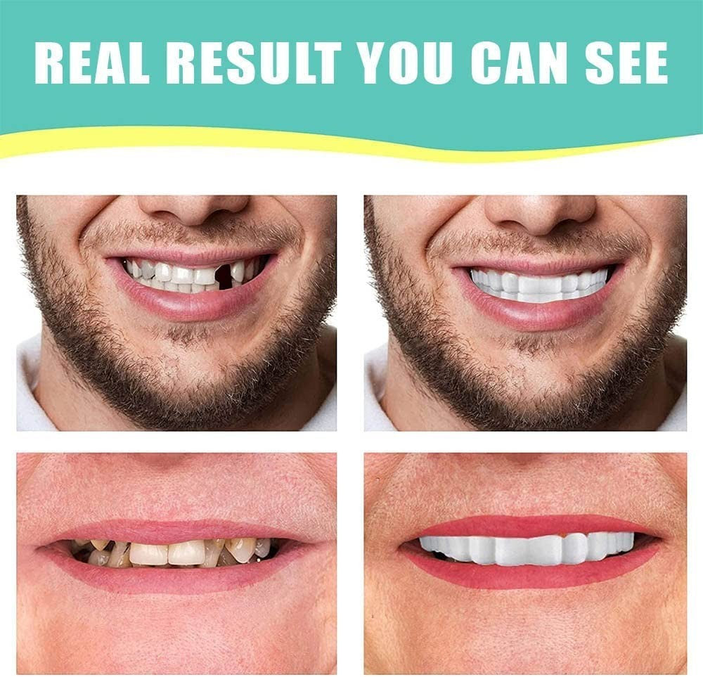 Dental Veneers & Denture Covers Set - Reusable Food-Grade Silicone, Cosmetic & Orthodontic Use