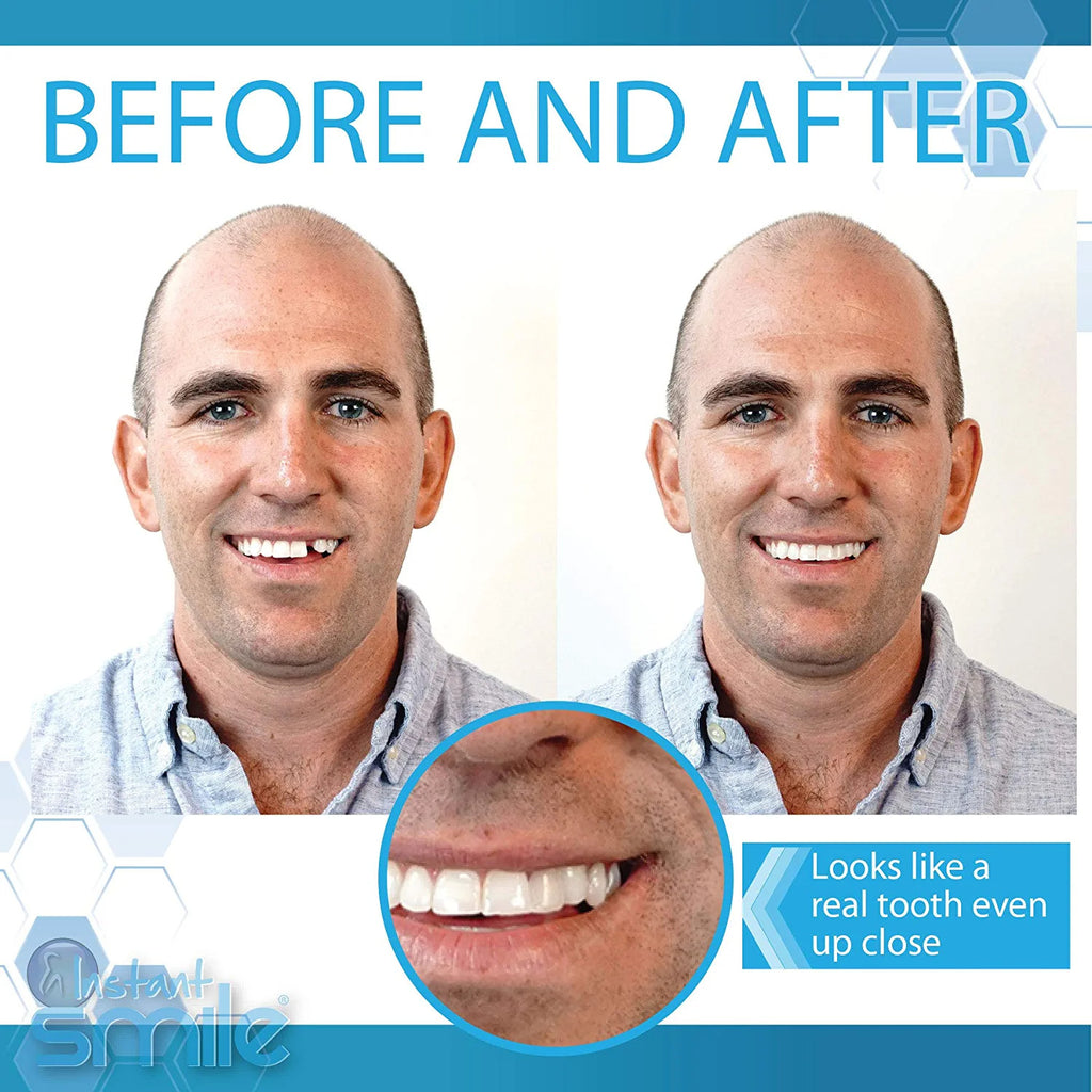 Instant Smile Complete Temporary Tooth Replacement Kit - Natural Look