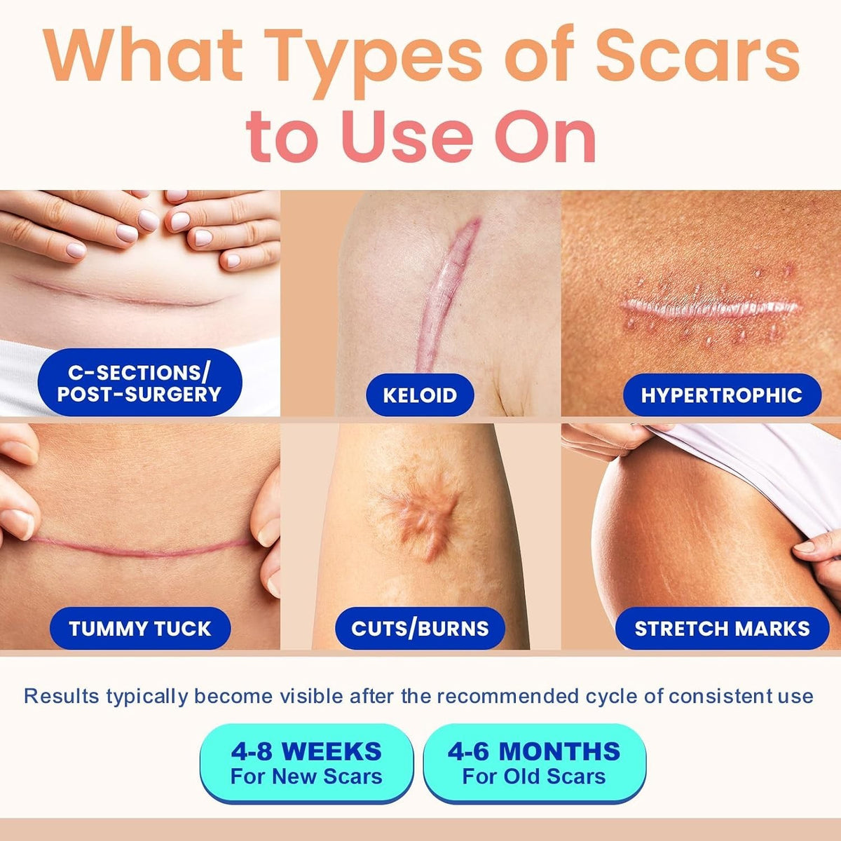 Silicone Scar Tape for Surgical & Keloid Scars - Reusable, Flexible & Breathable