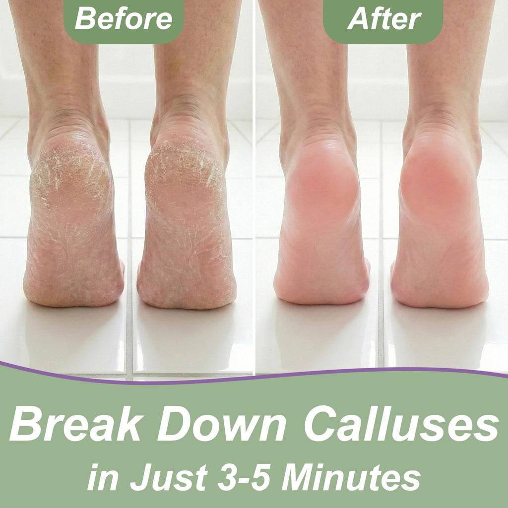 Extra Strength Foot Callus Remover Gel - 16 oz Professional Foot Care Treatment