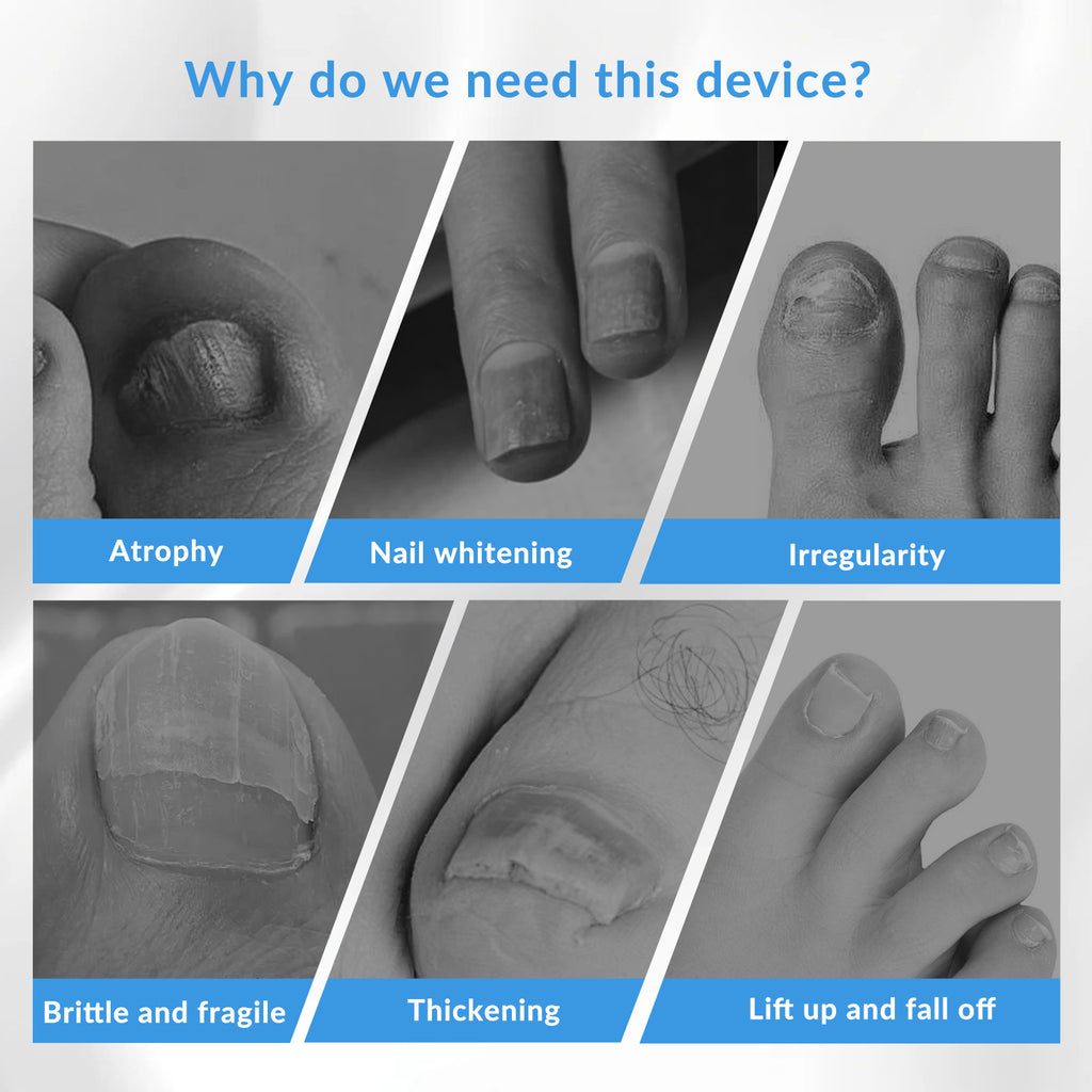 Nail Fungus Laser Treatment Device for Toenail & Fingernail Care